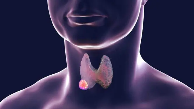 Thyroid Cancer