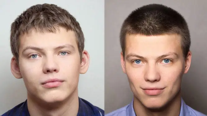 Boy after plastic surgery of the ear