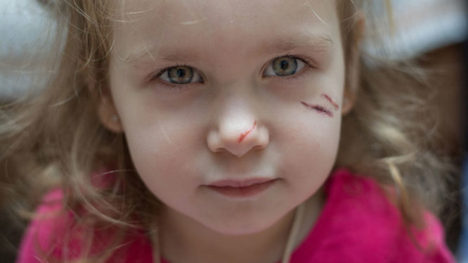 Young girl with traumatic facial injuries